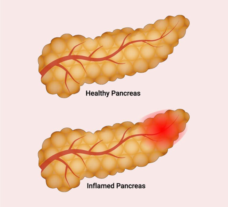 Symptoms of Pancreatitis