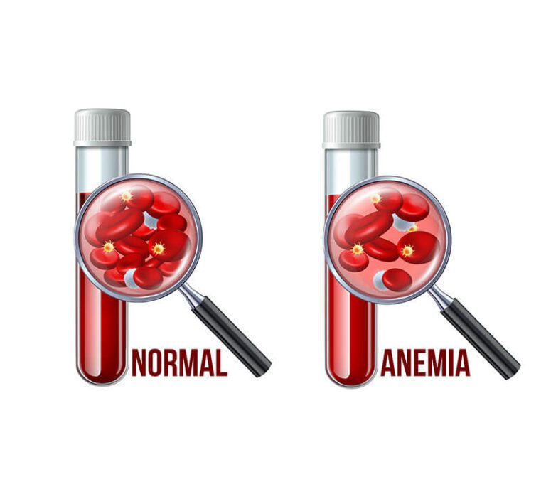 Anaemia medical condition