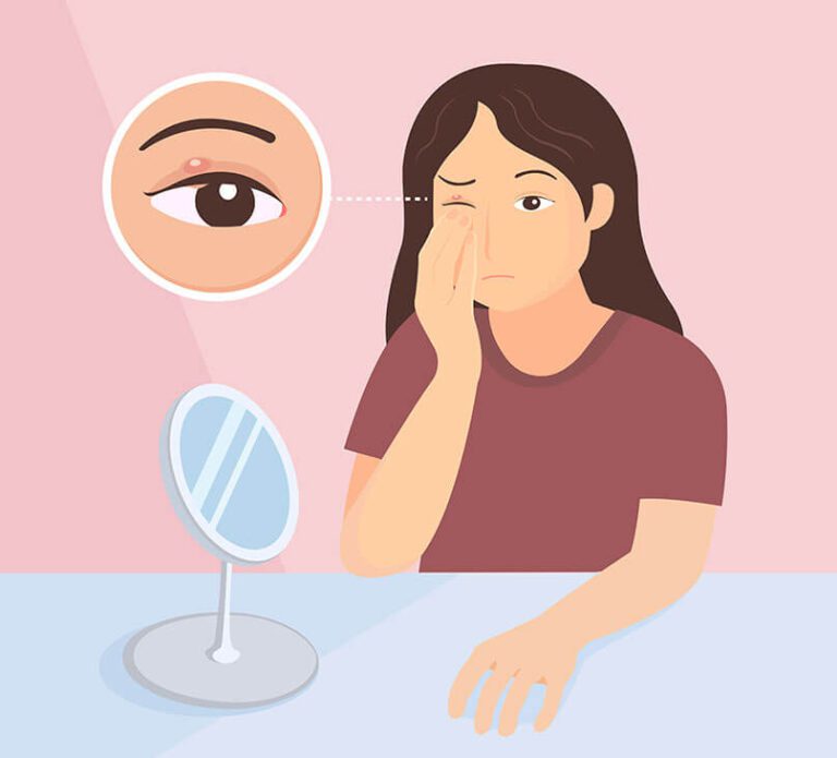 Symptoms of Chalazion