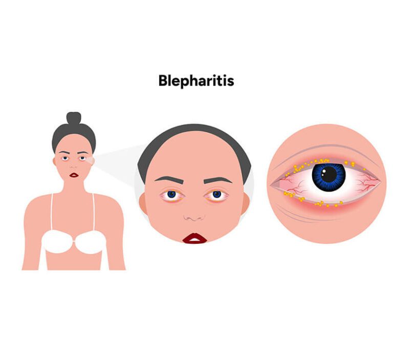 Causes of Chalazion