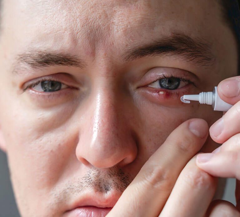 Homeopathic Treatment for Chalazion