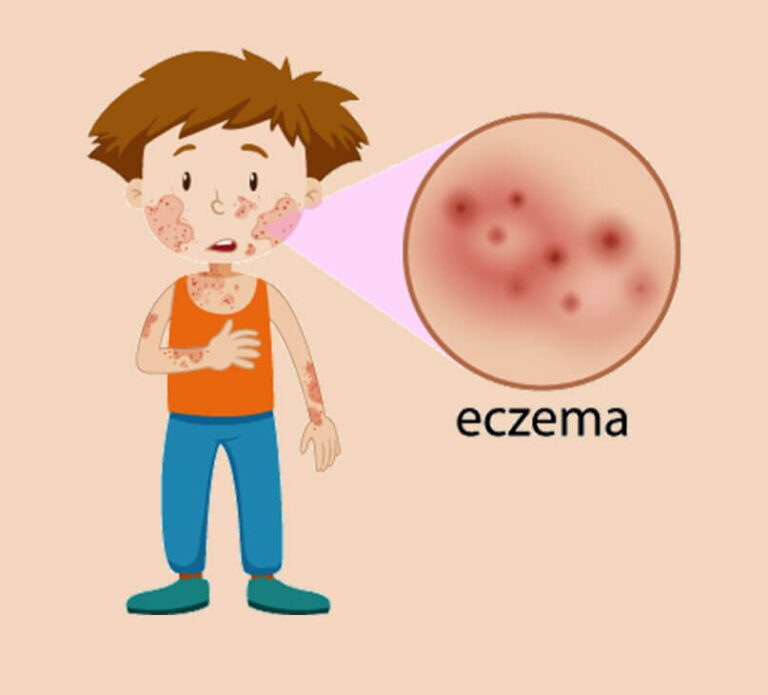 Symptoms of Eczema