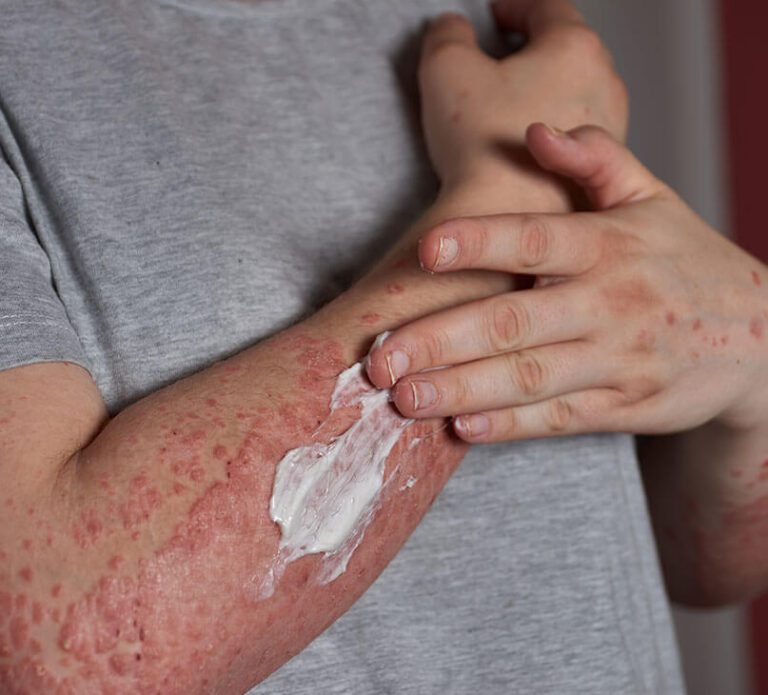 Treatment for Eczema