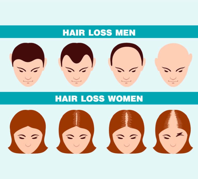 female-male-alopecia-balding-stages