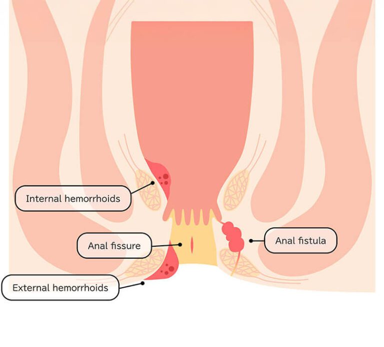 Causes of Fissure-in-Ano