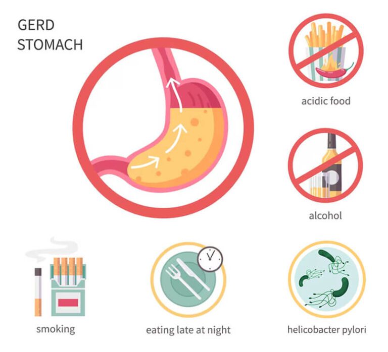 Causes of GERD