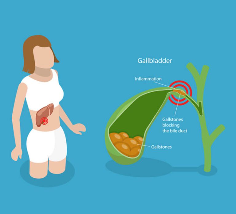 illustration-gallstone-disease