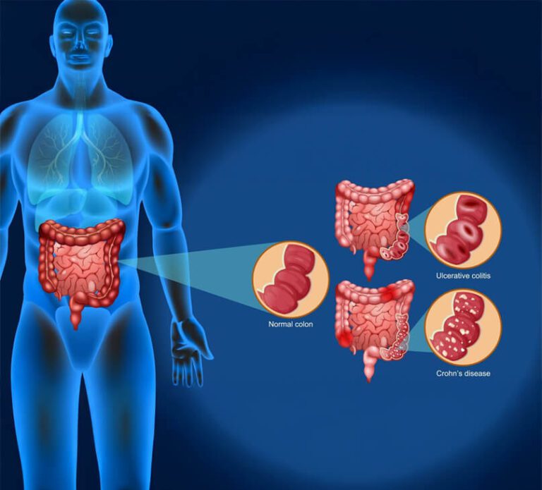 inflammatory-bowel-disease-ibd-infographic