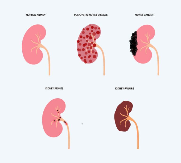 kidney-disease-concept