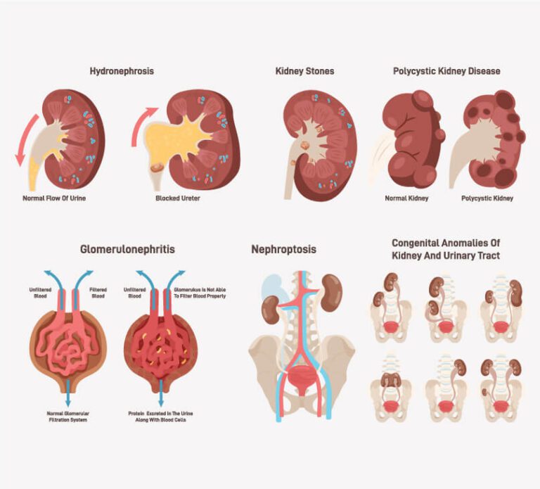 kidney-diseases