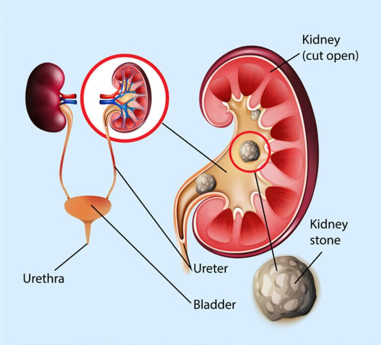 kidney-stones-illustration