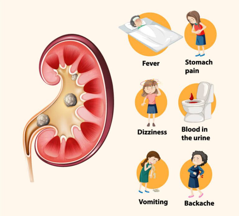 kidney-stones-symptoms