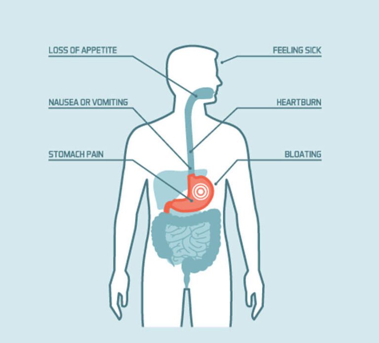 Symptoms of Peptic Ulcers