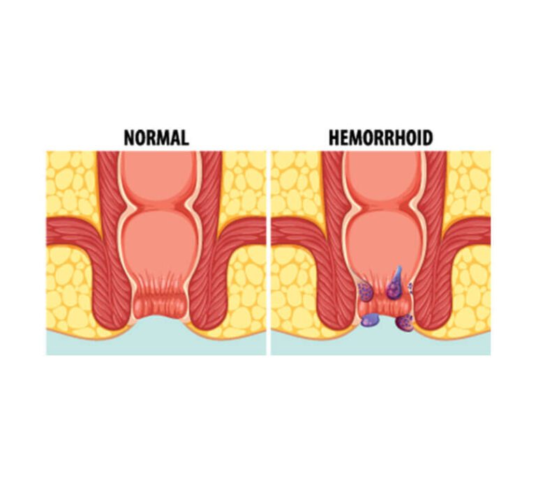 Grades of Haemorrhoids