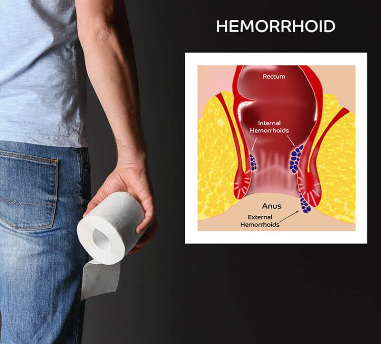 Haemorrhoids (Piles)