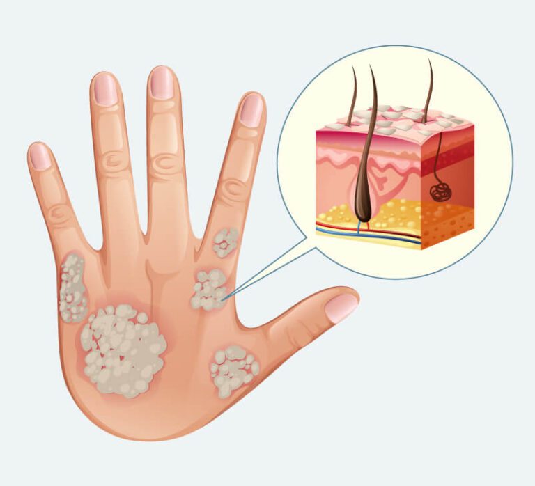 Treatment for Psoriasis