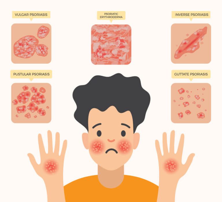 Symptoms of Psoriasis