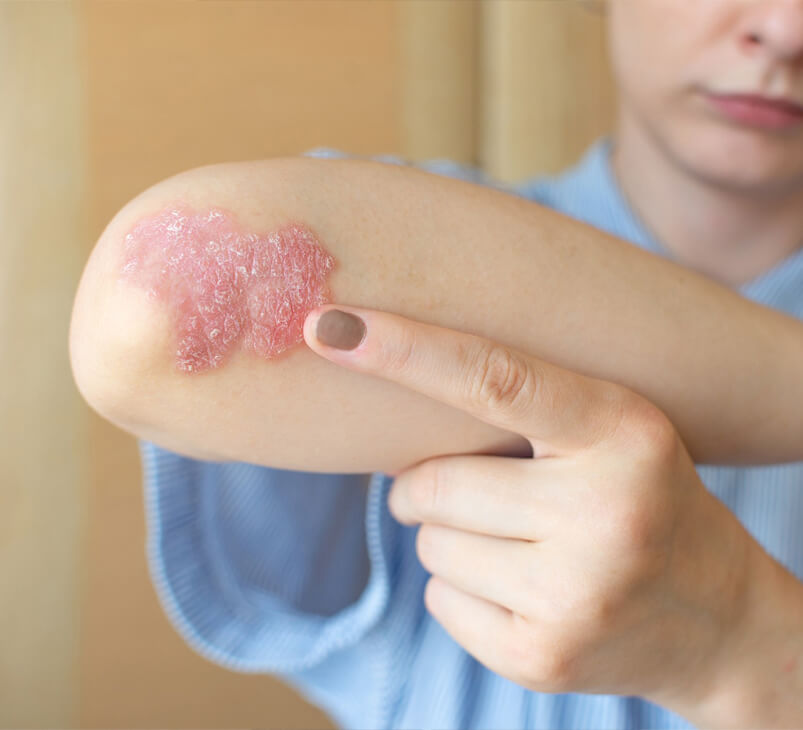 psoriasis-women-her-elbows