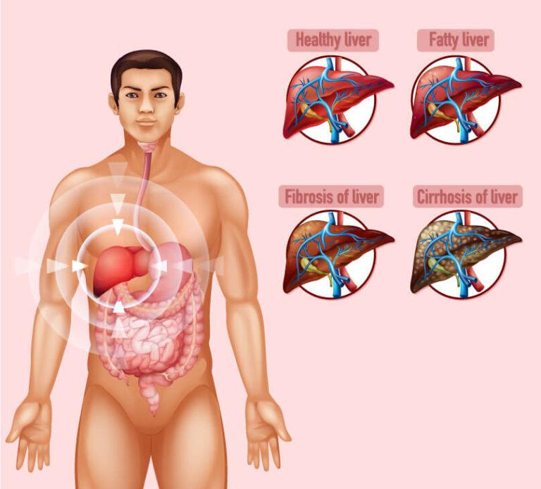 stages-liver-disease