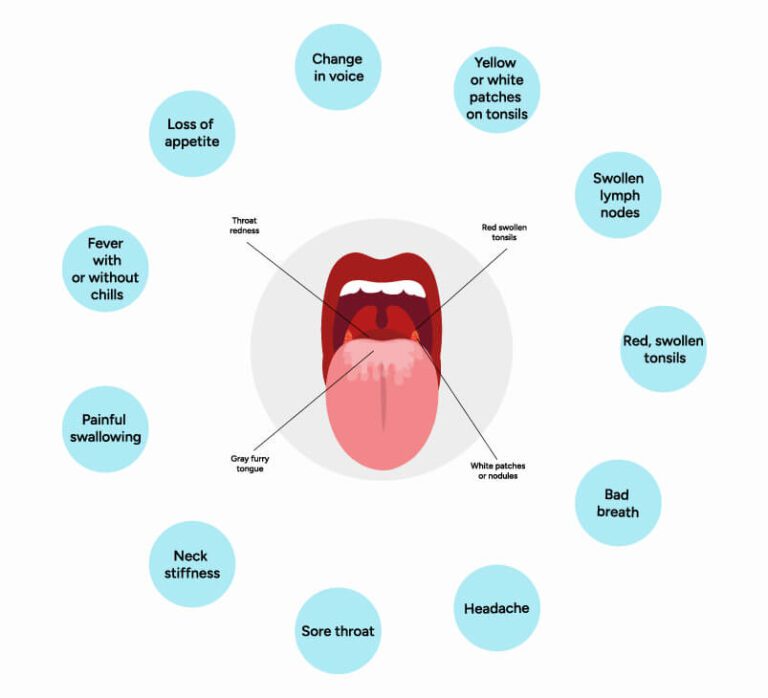 Symptoms of Tonsillitis and Tonsil Stones