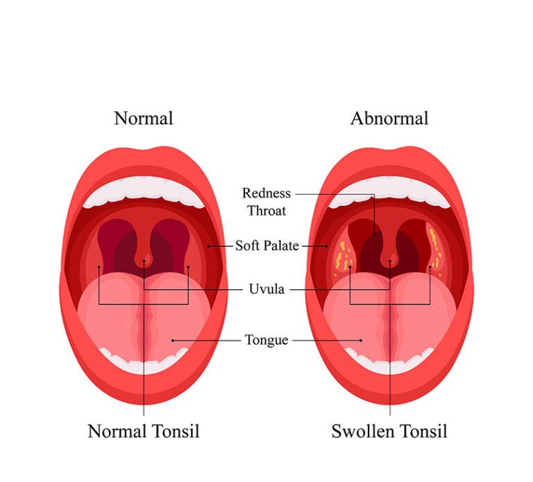 Causes of Tonsillitis and Tonsil Stones