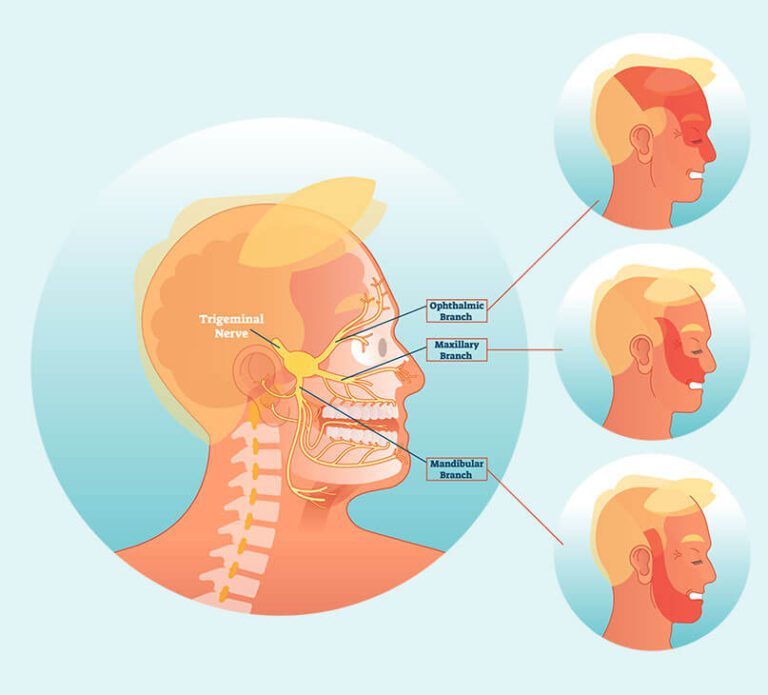 Causes of Trigeminal Neuralgia