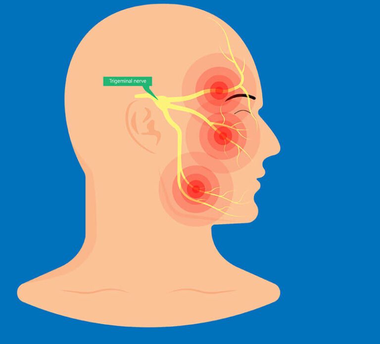 Symptoms of Trigeminal Neuralgia