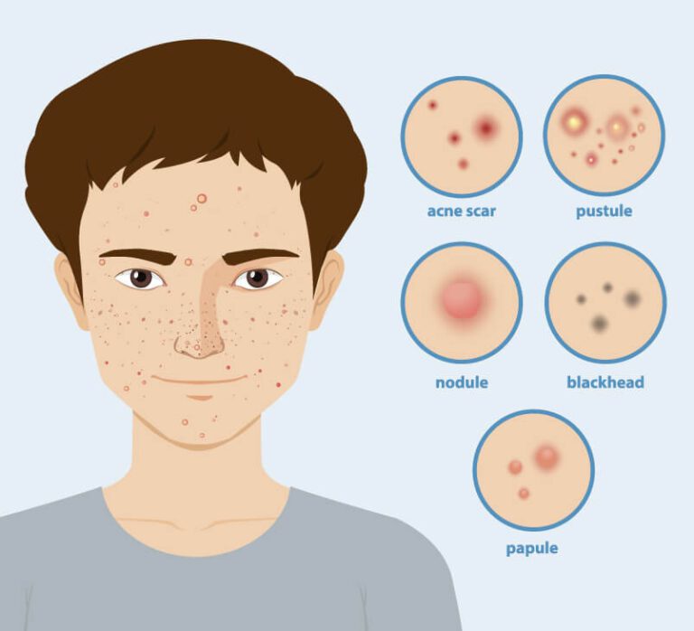 Symptoms of Acne