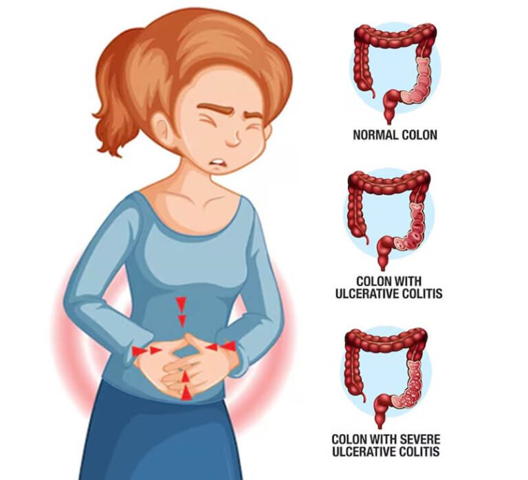 Causes of Ulcerative Colitis Disease