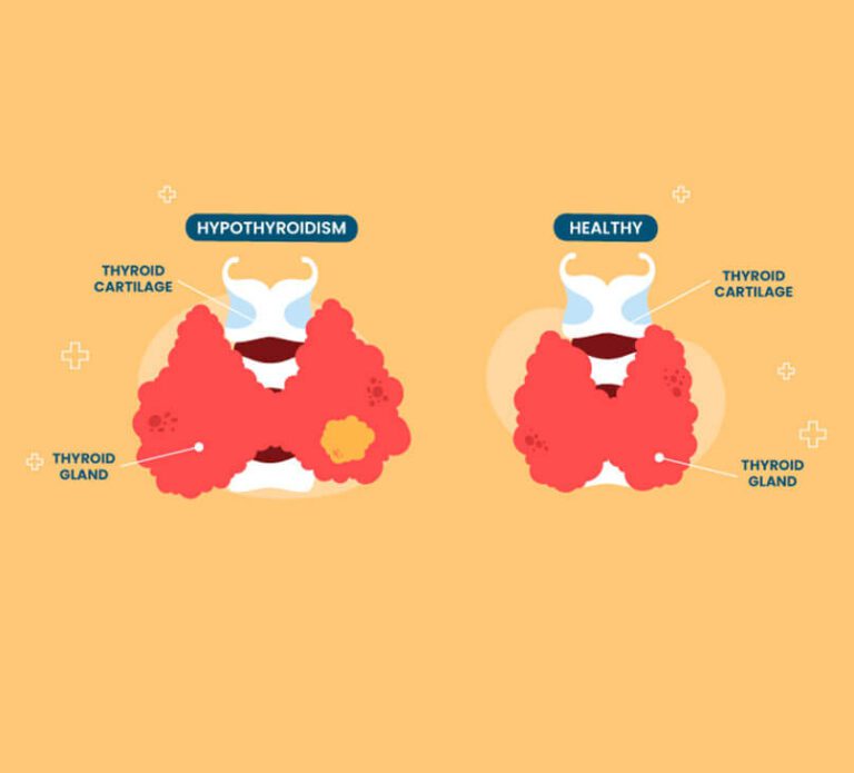 Causes of Underactive Thyroid