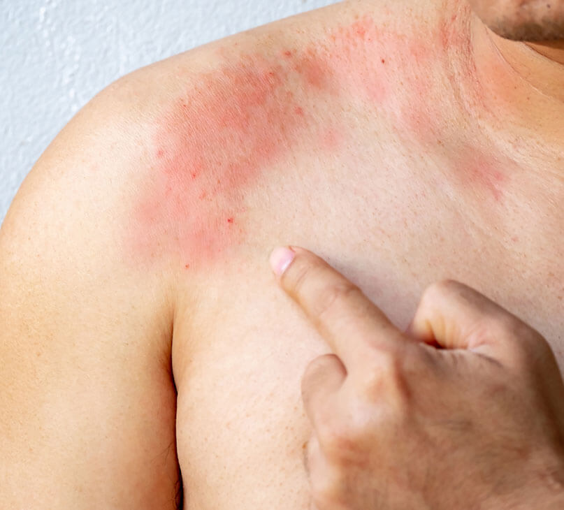 Causes of Urticaria and Hives