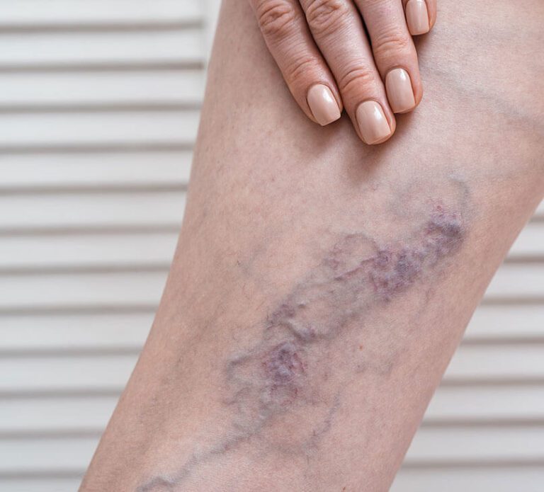 Conventional treatments for Varicose Veins