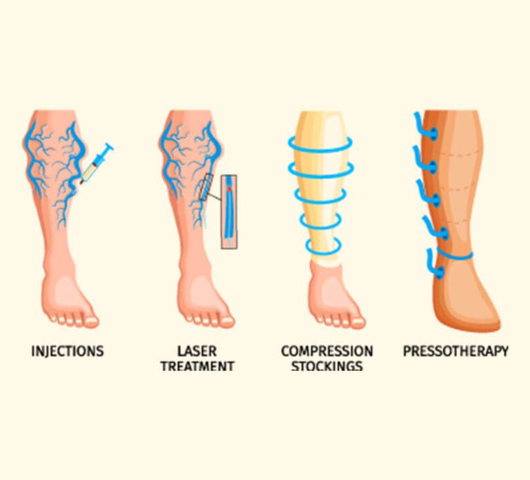 Conventional treatments for Varicose Veins