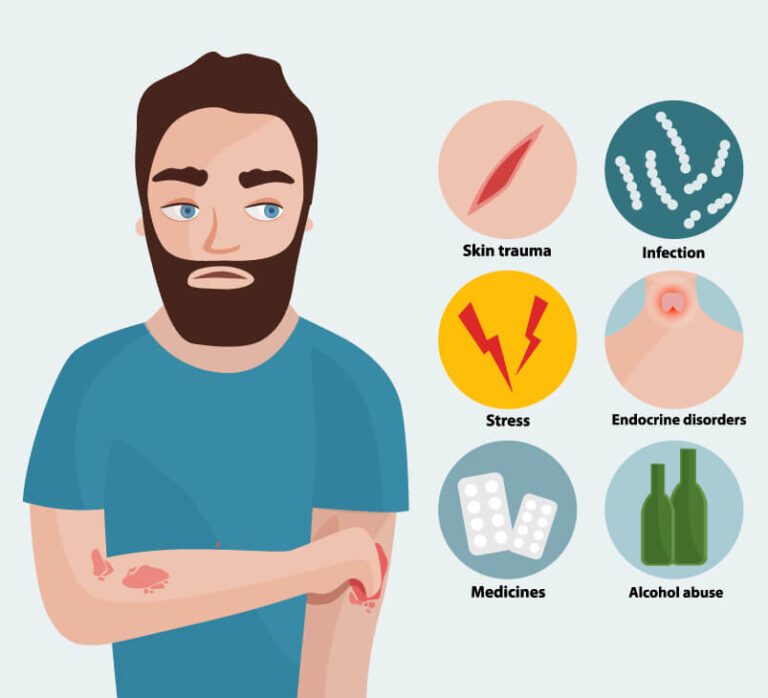 Causes of Psoriasis