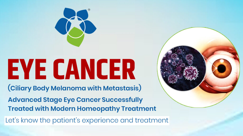 Advanced Stage Eye Cancer Successfully Treated with Modern Homeopathy Treatment